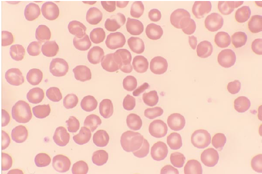 HEMOGLOBINOSIS/HEMOGLOBINOPATHIES – Sickle Cell (SCA) – Drs Dairy