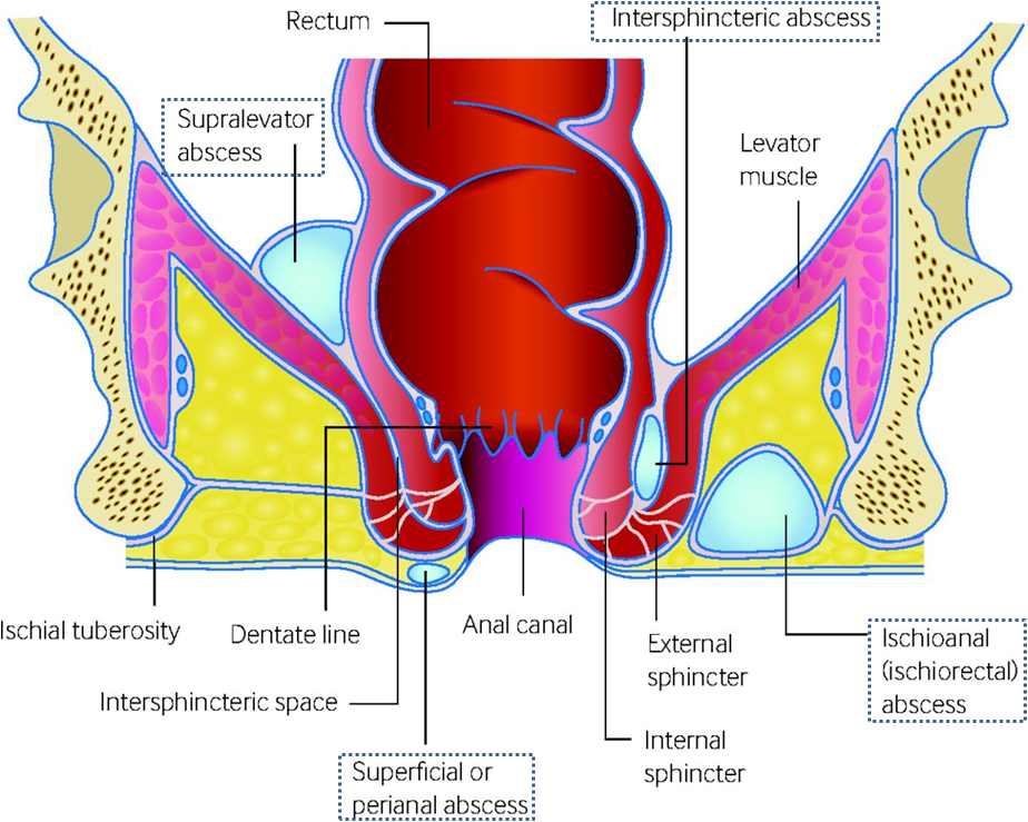 cross-section-and-a-direct-view-of-the-anus-with-a-fissure-media